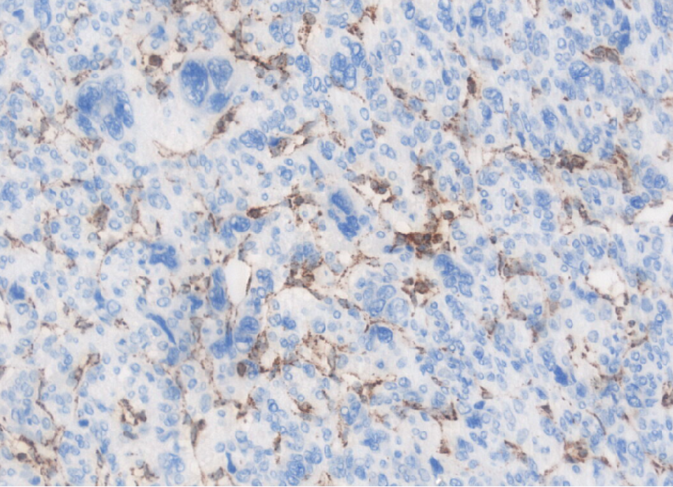 fh染色是什么意思讲座｜ FH缺失型子宫平滑肌瘤_https://www.jmylbn.com_新闻资讯_第26张