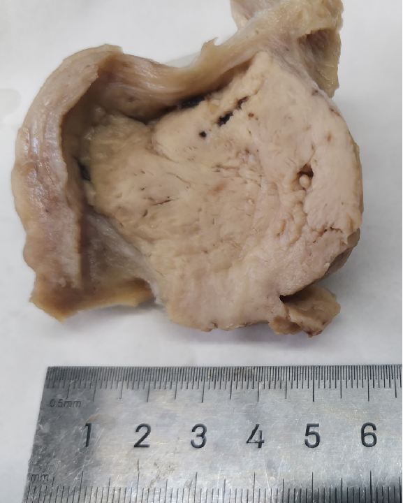 fh染色是什么意思讲座｜ FH缺失型子宫平滑肌瘤_https://www.jmylbn.com_新闻资讯_第4张