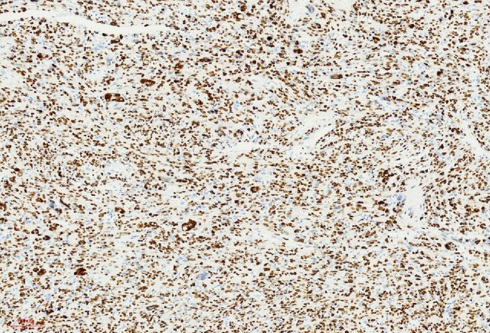 fh染色是什么意思讲座｜ FH缺失型子宫平滑肌瘤_https://www.jmylbn.com_新闻资讯_第29张