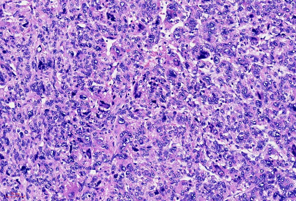 fh染色是什么意思讲座｜ FH缺失型子宫平滑肌瘤_https://www.jmylbn.com_新闻资讯_第16张