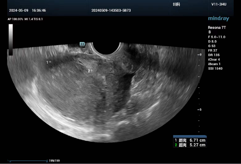 fh染色是什么意思讲座｜ FH缺失型子宫平滑肌瘤_https://www.jmylbn.com_新闻资讯_第3张