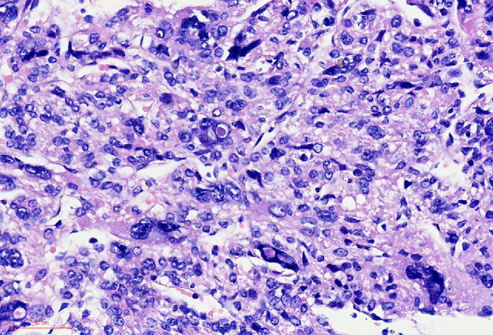 fh染色是什么意思讲座｜ FH缺失型子宫平滑肌瘤_https://www.jmylbn.com_新闻资讯_第20张