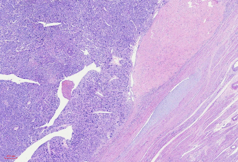 fh染色是什么意思讲座｜ FH缺失型子宫平滑肌瘤_https://www.jmylbn.com_新闻资讯_第7张