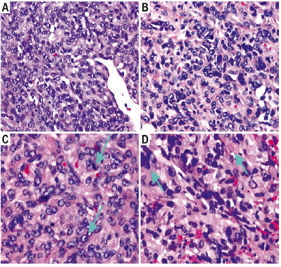 fh染色是什么意思讲座｜ FH缺失型子宫平滑肌瘤_https://www.jmylbn.com_新闻资讯_第33张
