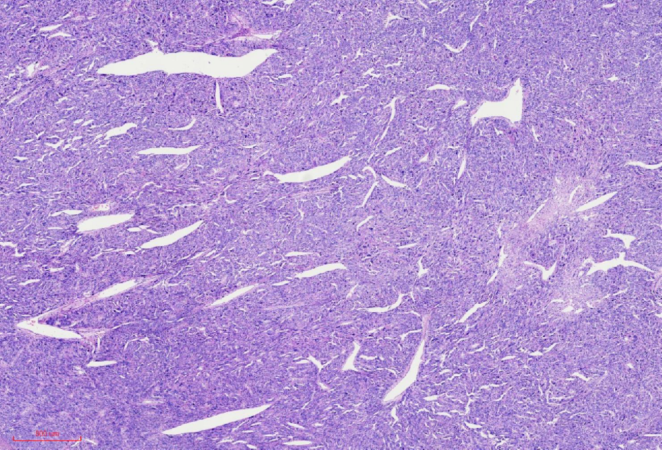 fh染色是什么意思讲座｜ FH缺失型子宫平滑肌瘤_https://www.jmylbn.com_新闻资讯_第9张