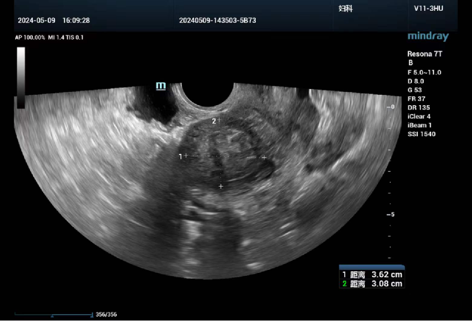 fh染色是什么意思讲座｜ FH缺失型子宫平滑肌瘤_https://www.jmylbn.com_新闻资讯_第2张