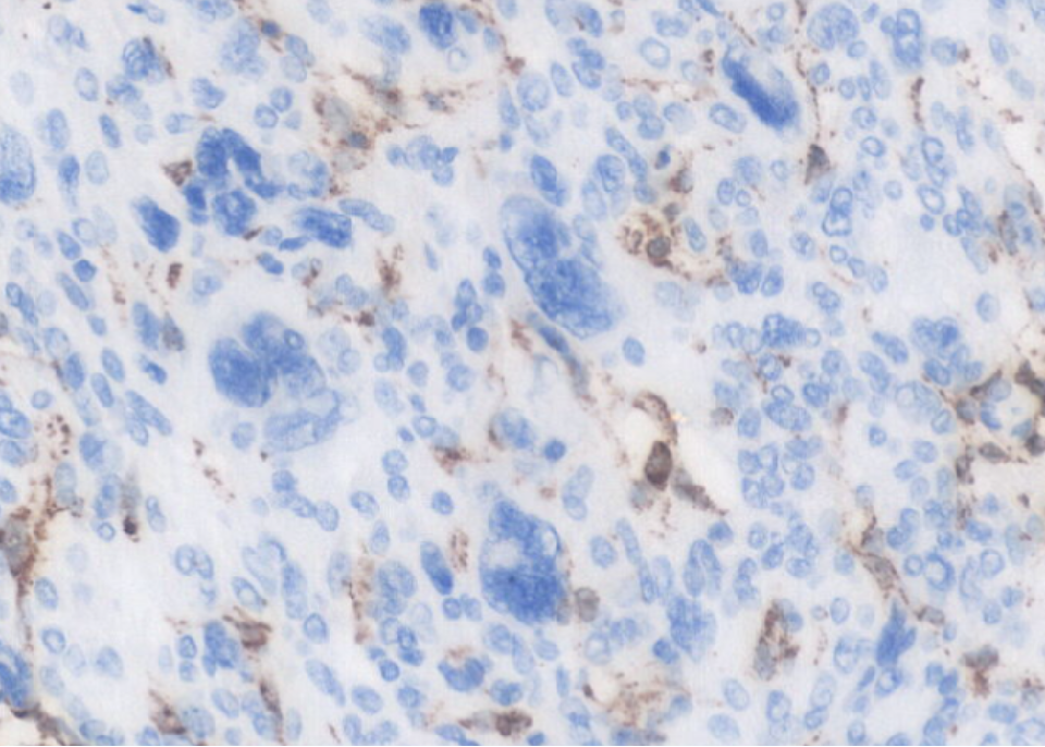 fh染色是什么意思讲座｜ FH缺失型子宫平滑肌瘤_https://www.jmylbn.com_新闻资讯_第27张