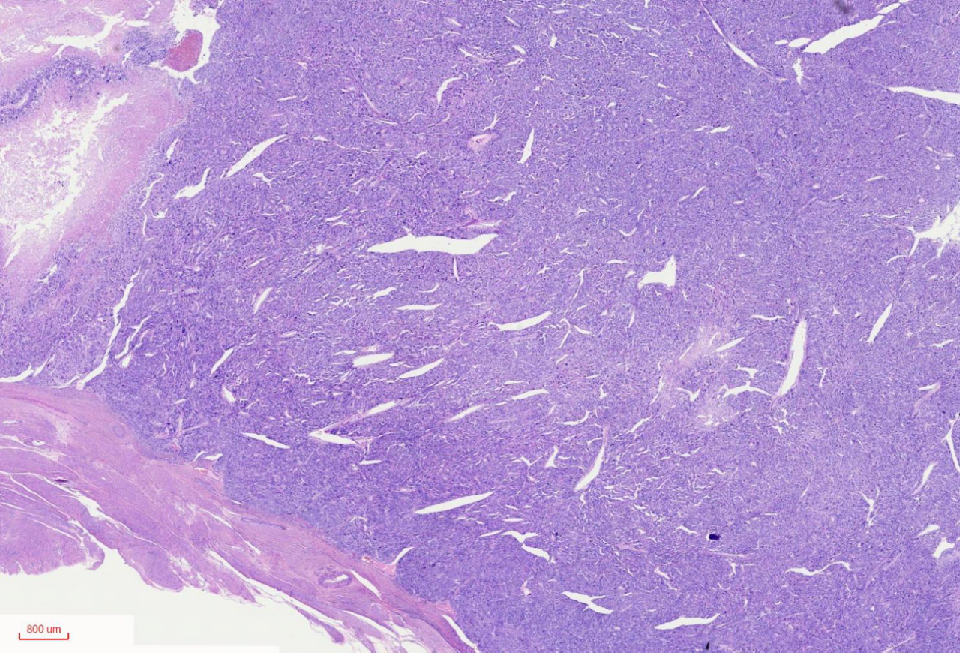 fh染色是什么意思讲座｜ FH缺失型子宫平滑肌瘤_https://www.jmylbn.com_新闻资讯_第5张