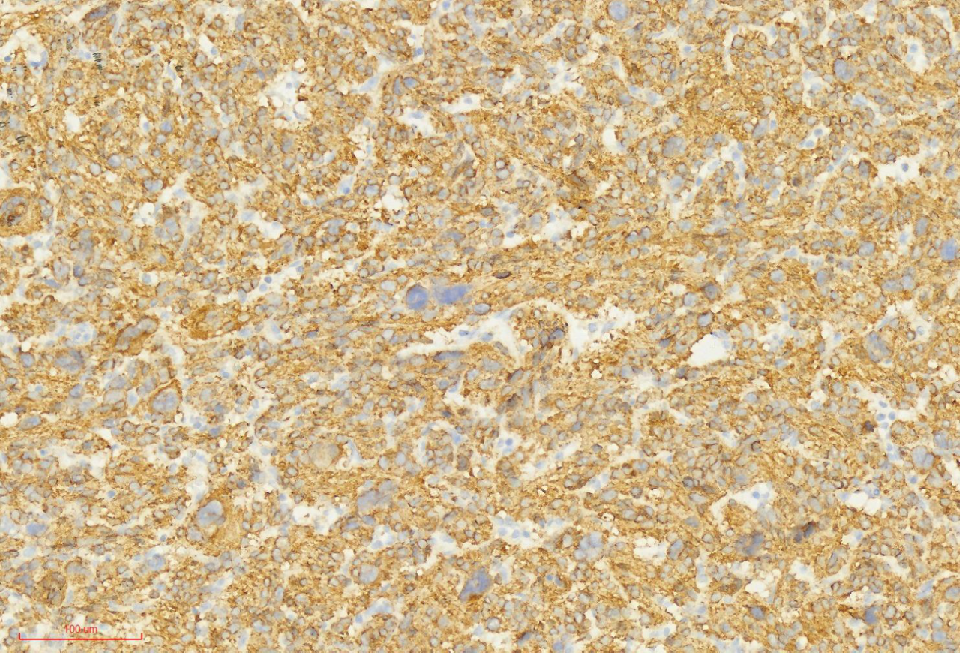 fh染色是什么意思讲座｜ FH缺失型子宫平滑肌瘤_https://www.jmylbn.com_新闻资讯_第24张