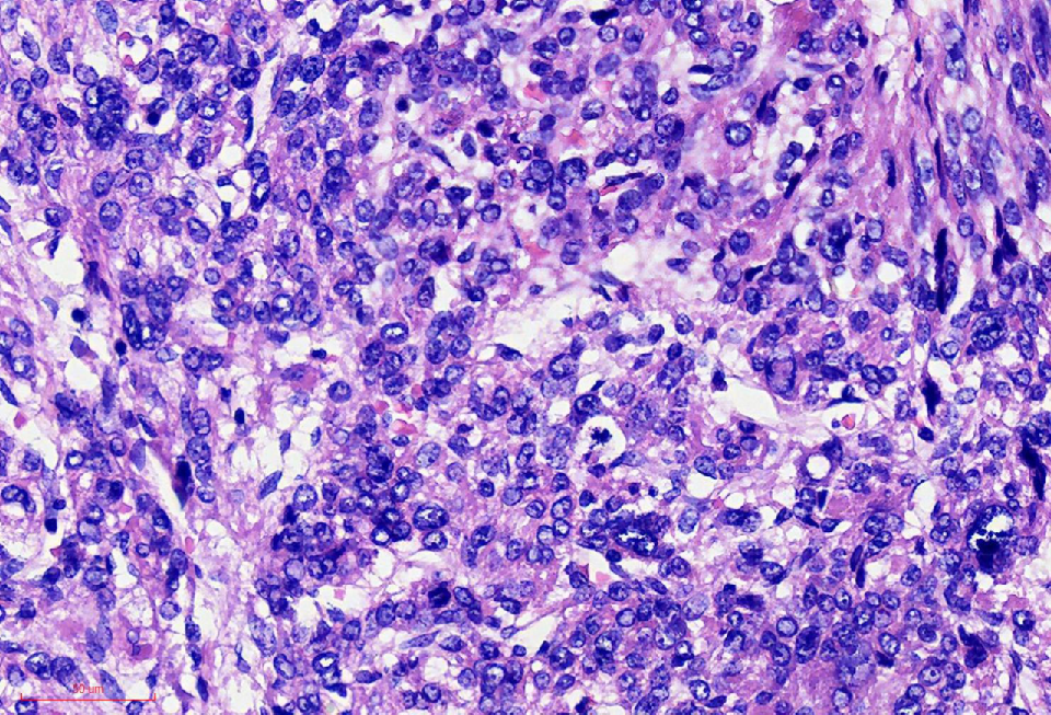 fh染色是什么意思讲座｜ FH缺失型子宫平滑肌瘤_https://www.jmylbn.com_新闻资讯_第19张