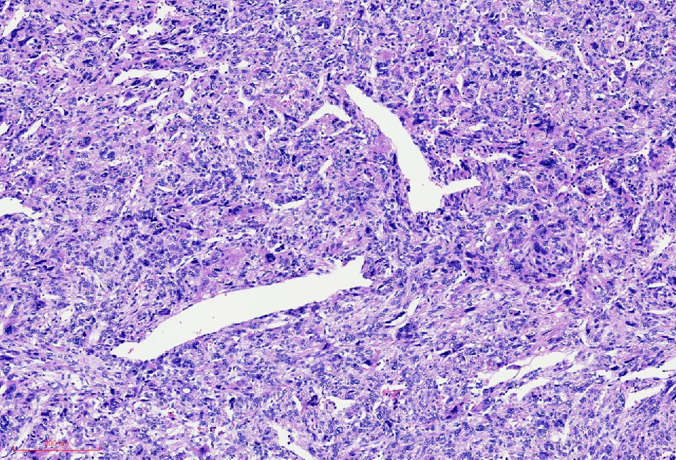 fh染色是什么意思讲座｜ FH缺失型子宫平滑肌瘤_https://www.jmylbn.com_新闻资讯_第12张