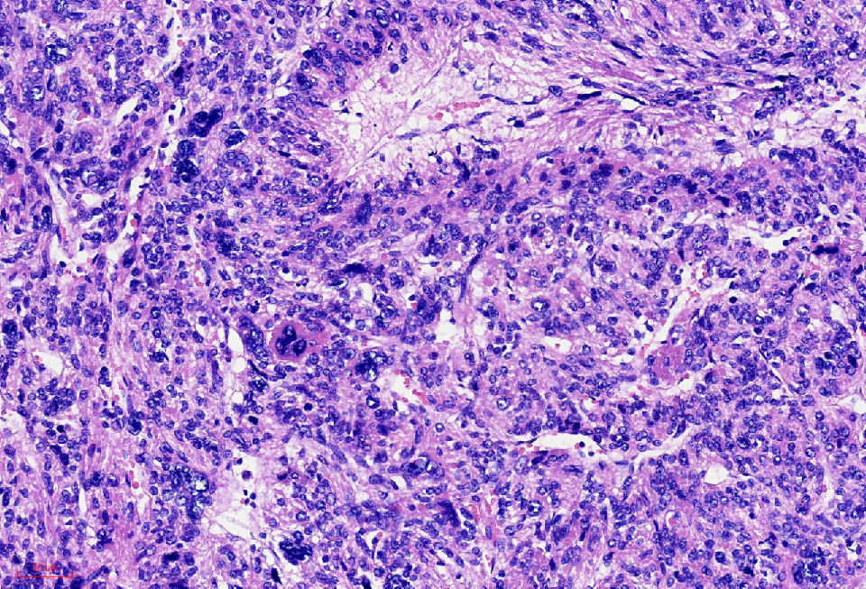 fh染色是什么意思讲座｜ FH缺失型子宫平滑肌瘤_https://www.jmylbn.com_新闻资讯_第13张