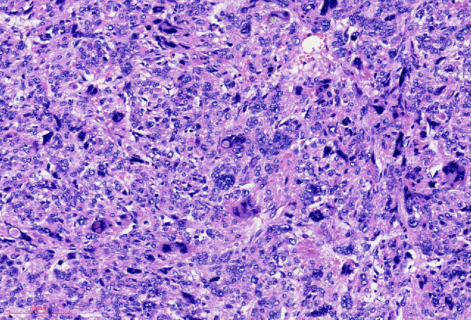 fh染色是什么意思讲座｜ FH缺失型子宫平滑肌瘤_https://www.jmylbn.com_新闻资讯_第14张