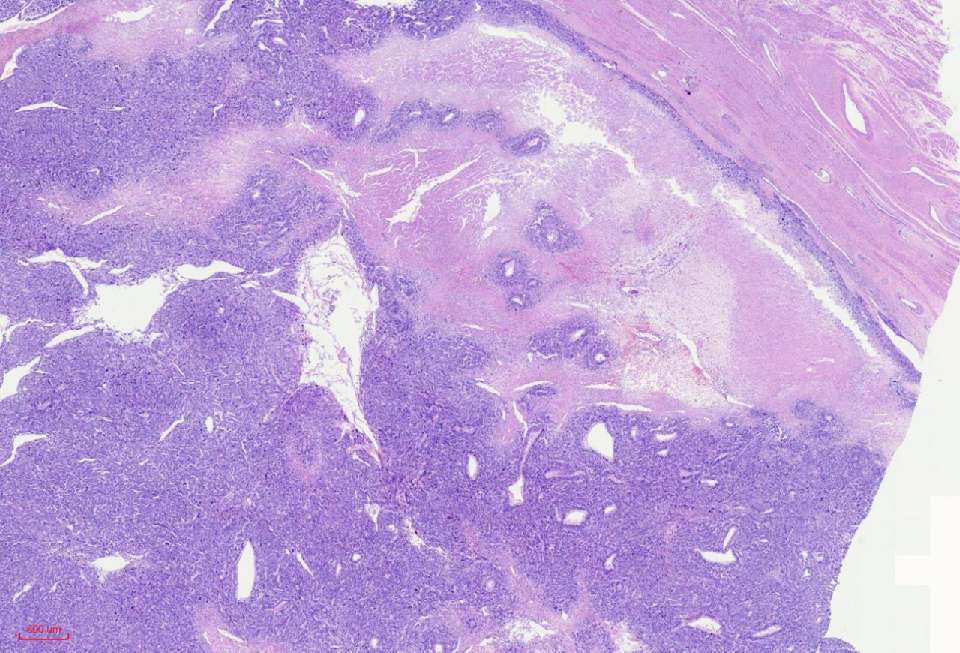 fh染色是什么意思讲座｜ FH缺失型子宫平滑肌瘤_https://www.jmylbn.com_新闻资讯_第6张