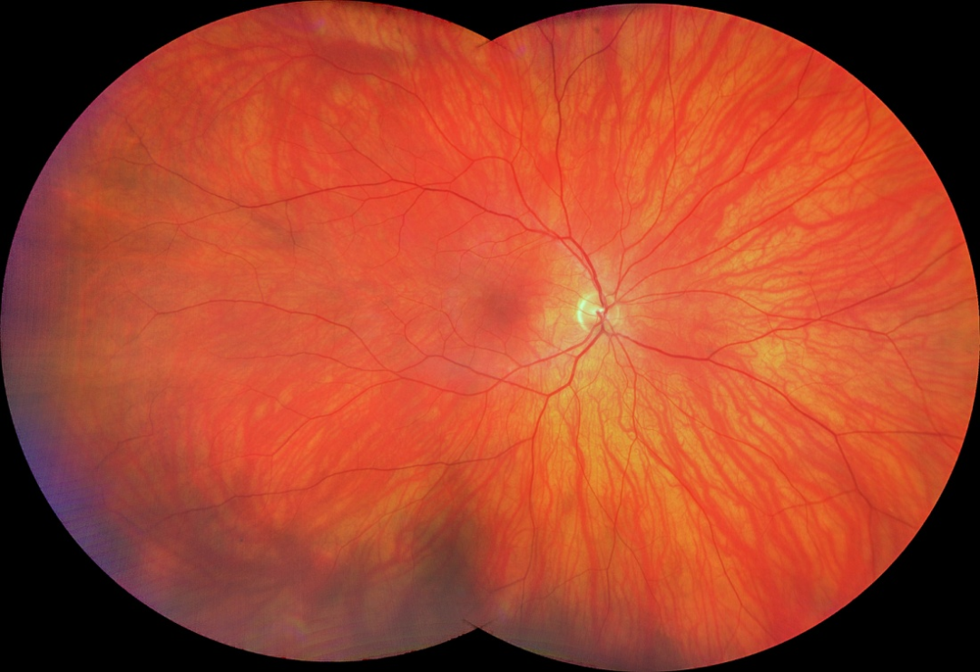 彩色眼底照相查什么拍一张眼底照片，就能帮你查清全身问题！_https://www.jmylbn.com_新闻资讯_第7张