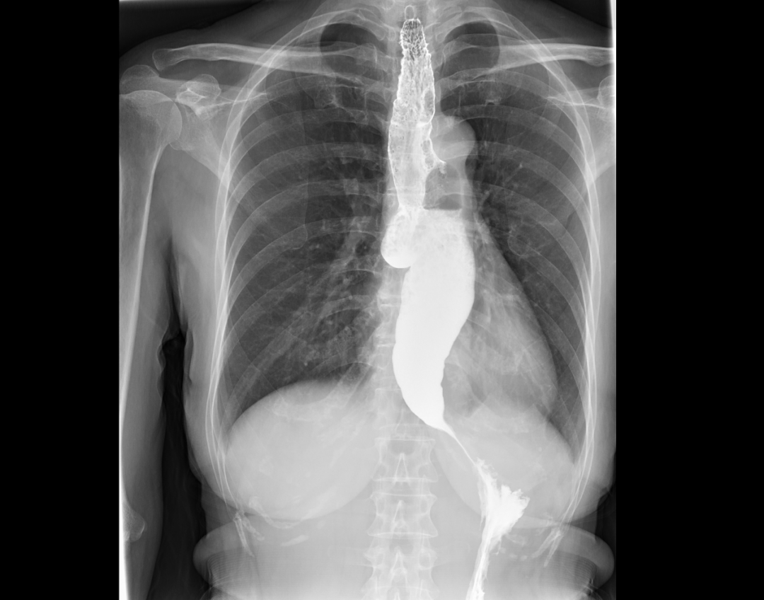 吞咽5900怎么使用【精湛医术】吞咽困难6年都找不到病因，在这里“一镜”解决病痛_https://www.jmylbn.com_新闻资讯_第4张