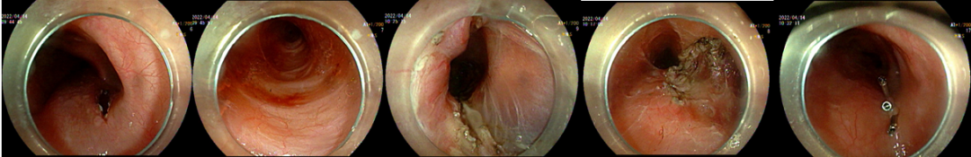 吞咽5900怎么使用【精湛医术】吞咽困难6年都找不到病因，在这里“一镜”解决病痛_https://www.jmylbn.com_新闻资讯_第7张