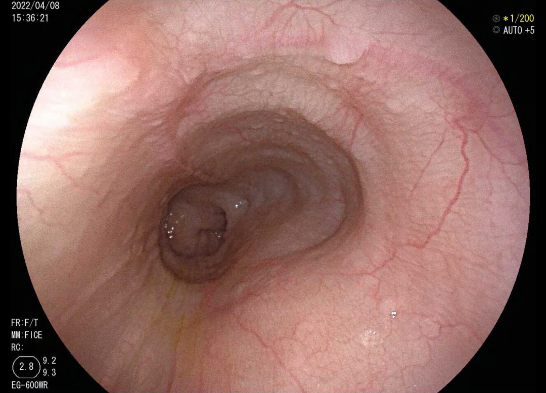 吞咽5900怎么使用【精湛医术】吞咽困难6年都找不到病因，在这里“一镜”解决病痛_https://www.jmylbn.com_新闻资讯_第2张