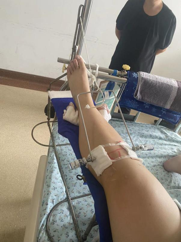 骨科直接牵引有哪些牵引：让骨头复位的好帮手_https://www.jmylbn.com_新闻资讯_第9张