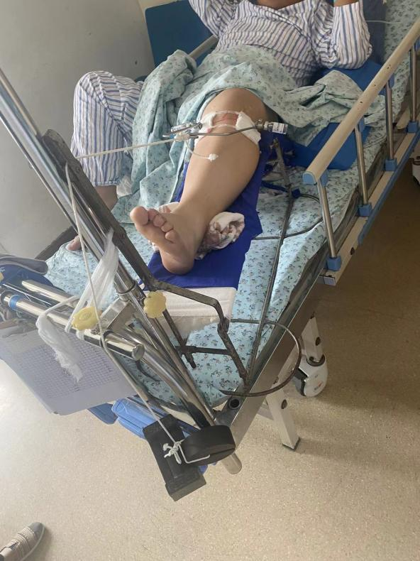 骨科直接牵引有哪些牵引：让骨头复位的好帮手_https://www.jmylbn.com_新闻资讯_第8张