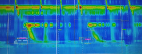 消化道动力检测怎么做【曲中科普】总是胃胀反酸却查不出问题？消化道动力检测来帮您！_https://www.jmylbn.com_新闻资讯_第3张
