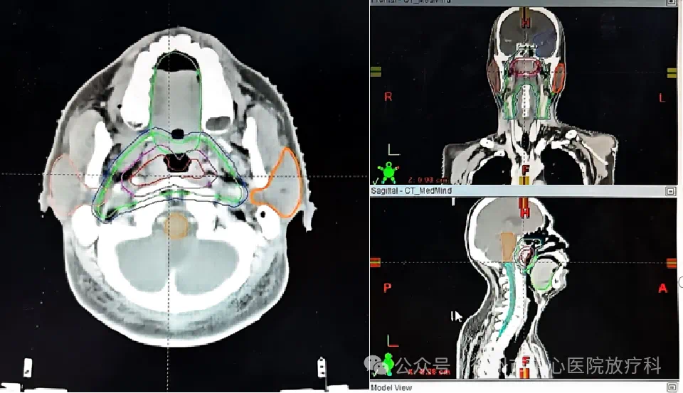 放疗体膜是什么全国肿瘤防治宣传周丨放疗模拟定位制模：精准抗癌的“导航地图”_https://www.jmylbn.com_新闻资讯_第4张