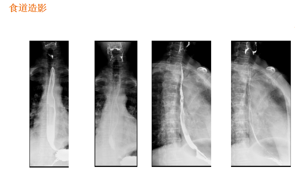 数字胃肠透视怎么做【先进设备】放射检查的“高清透视镜”：西门子Luminos dRF Max超高端数字胃肠机开启运行_https://www.jmylbn.com_新闻资讯_第3张