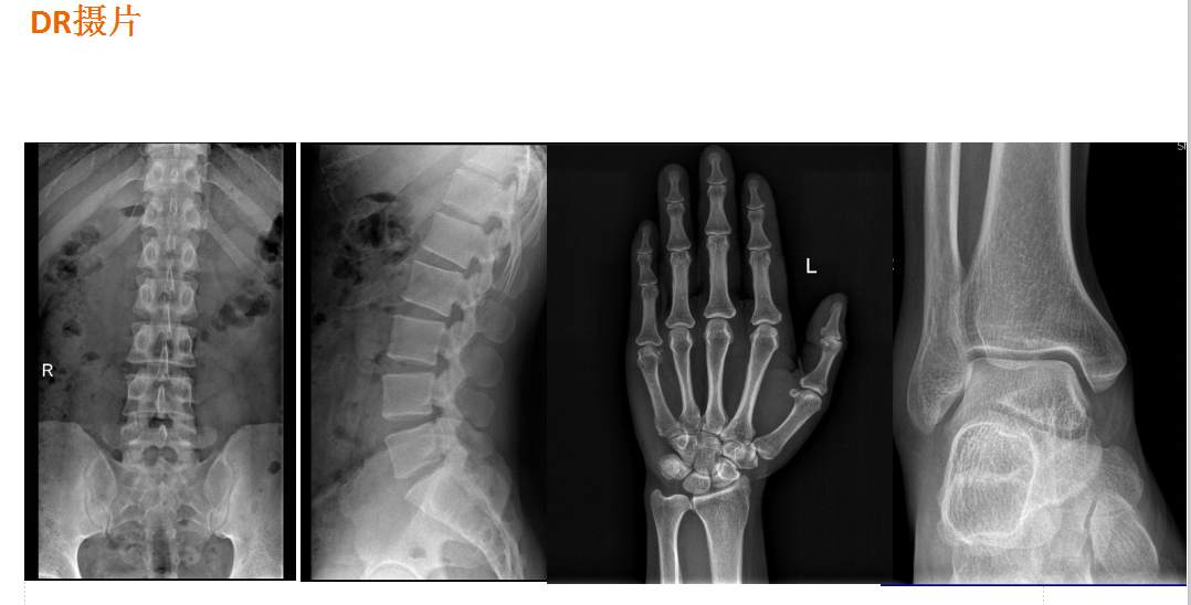 数字胃肠透视怎么做【先进设备】放射检查的“高清透视镜”：西门子Luminos dRF Max超高端数字胃肠机开启运行_https://www.jmylbn.com_新闻资讯_第13张