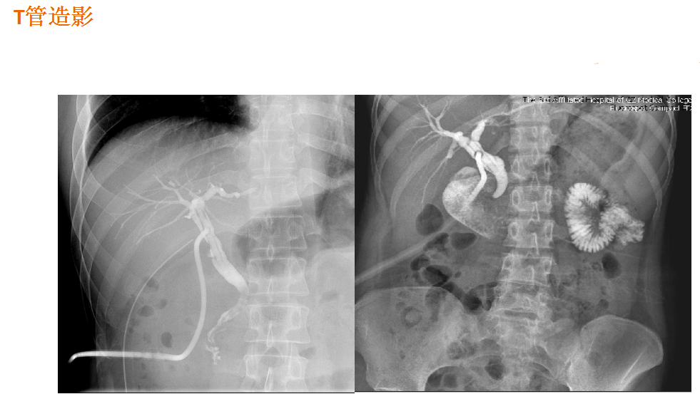 数字胃肠透视怎么做【先进设备】放射检查的“高清透视镜”：西门子Luminos dRF Max超高端数字胃肠机开启运行_https://www.jmylbn.com_新闻资讯_第7张