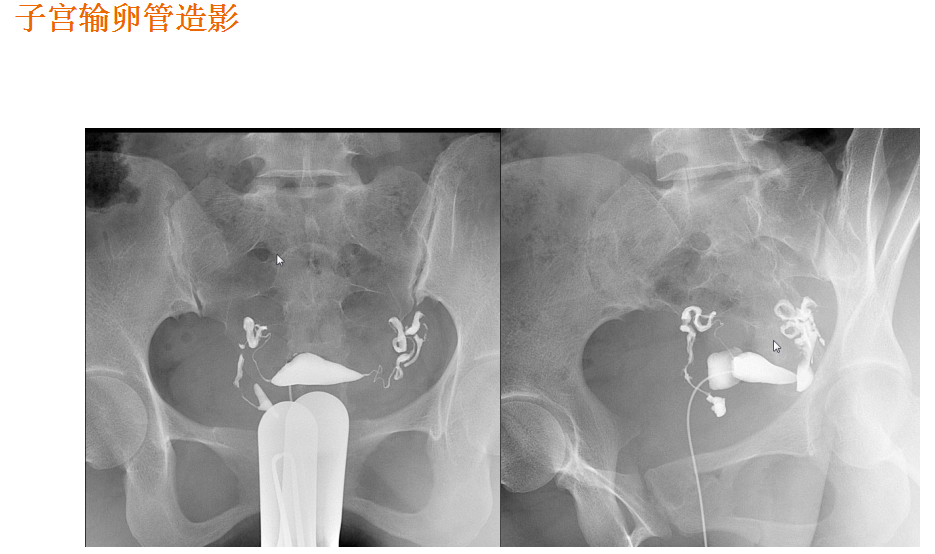 数字胃肠透视怎么做【先进设备】放射检查的“高清透视镜”：西门子Luminos dRF Max超高端数字胃肠机开启运行_https://www.jmylbn.com_新闻资讯_第15张