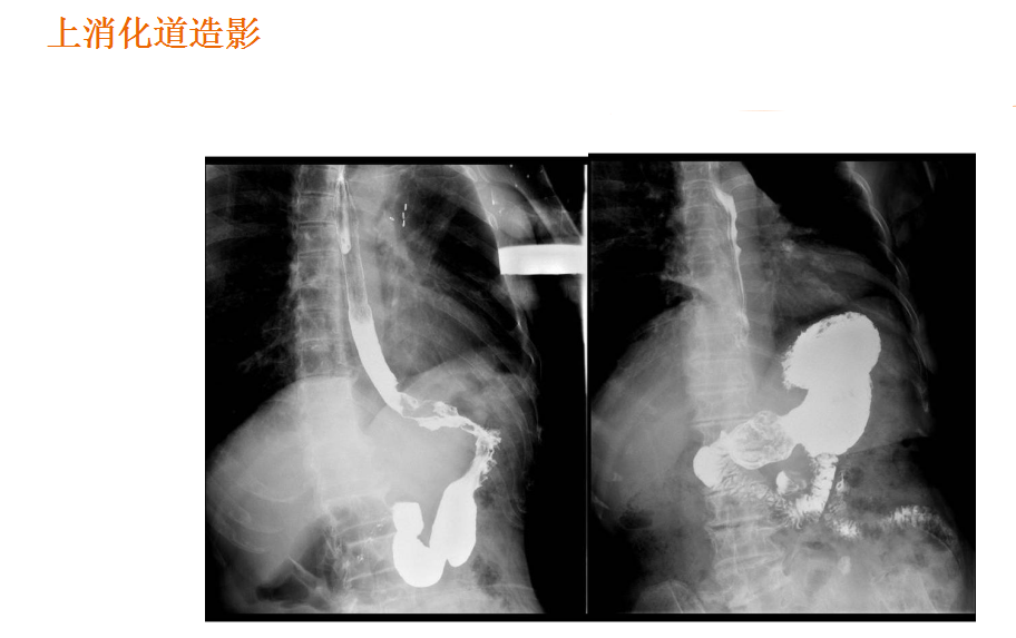 数字胃肠透视怎么做【先进设备】放射检查的“高清透视镜”：西门子Luminos dRF Max超高端数字胃肠机开启运行_https://www.jmylbn.com_新闻资讯_第5张