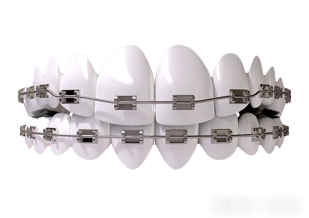 牙齿矫正攻略金属矫正与隐形矫正的利弊分析