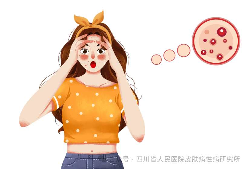 脂溢性皮炎——病因探寻，“溢”起调理