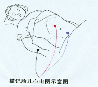 胎儿心电图是什么意思【科普】胎儿也可以做心电图了！您知道吗？_https://www.jmylbn.com_新闻资讯_第5张