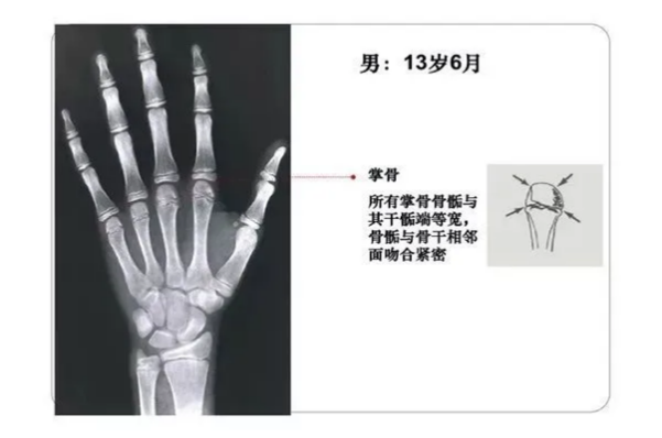 儿童骨龄图谱手腕图片