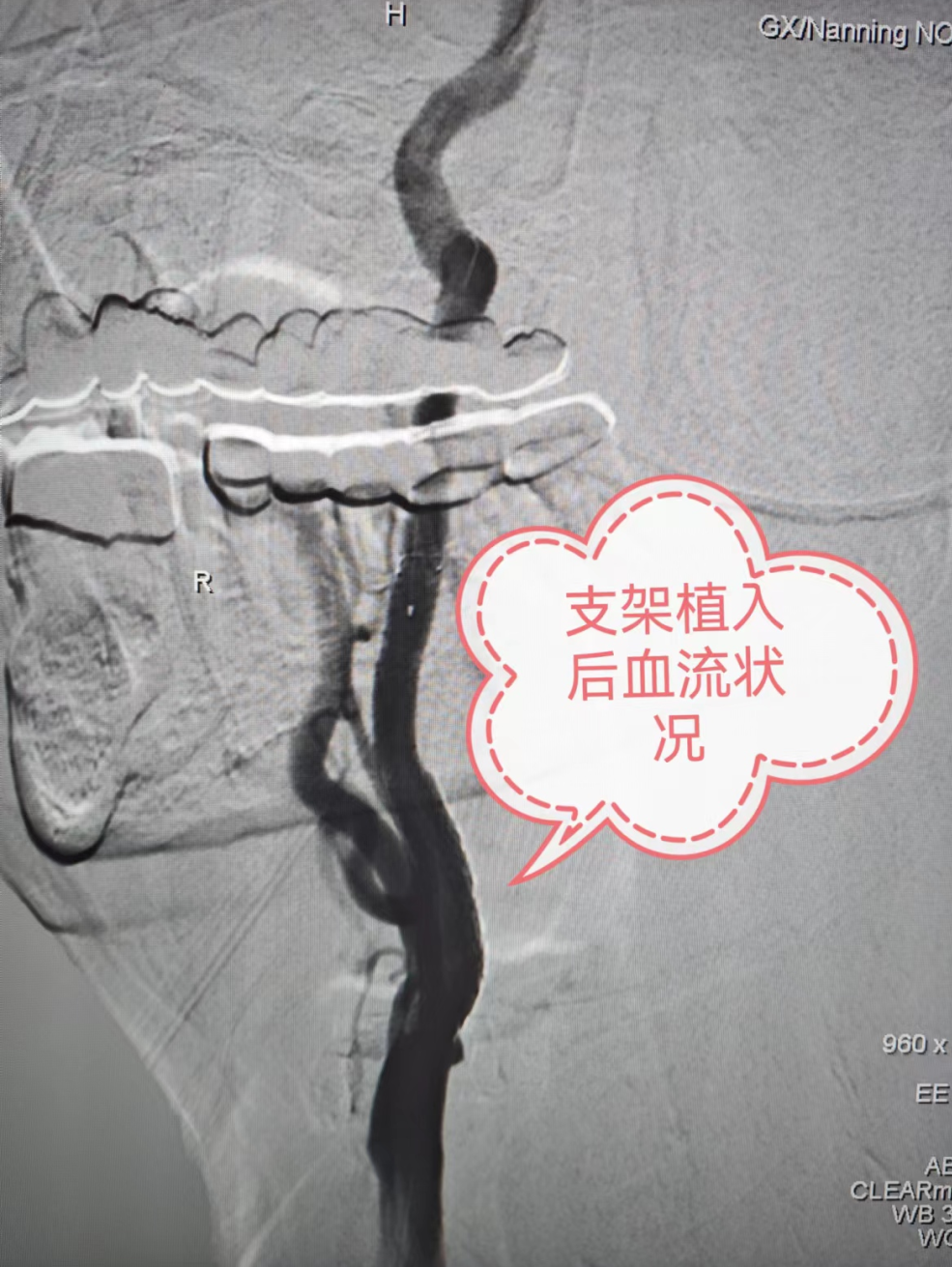 动脉长鞘怎么置入突破旧有，探索无限——我院神经科一区完成首例在血管长鞘辅助下经桡动脉穿刺行颈内动脉支架植入术_https://www.jmylbn.com_新闻资讯_第4张