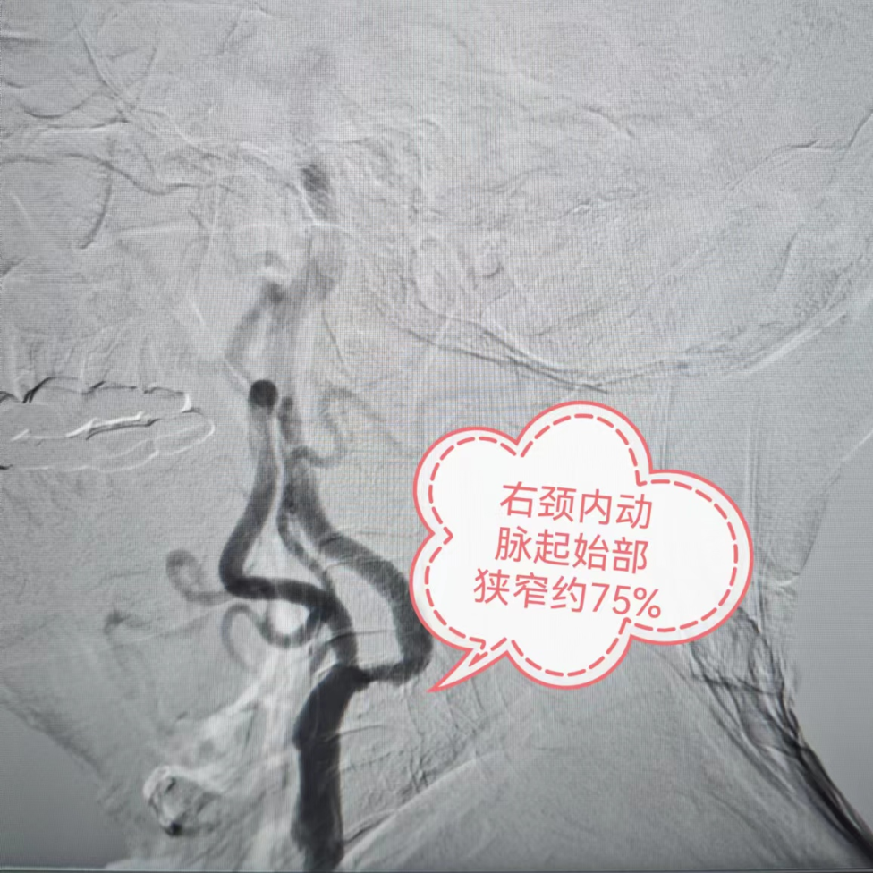 动脉长鞘怎么置入突破旧有，探索无限——我院神经科一区完成首例在血管长鞘辅助下经桡动脉穿刺行颈内动脉支架植入术_https://www.jmylbn.com_新闻资讯_第3张