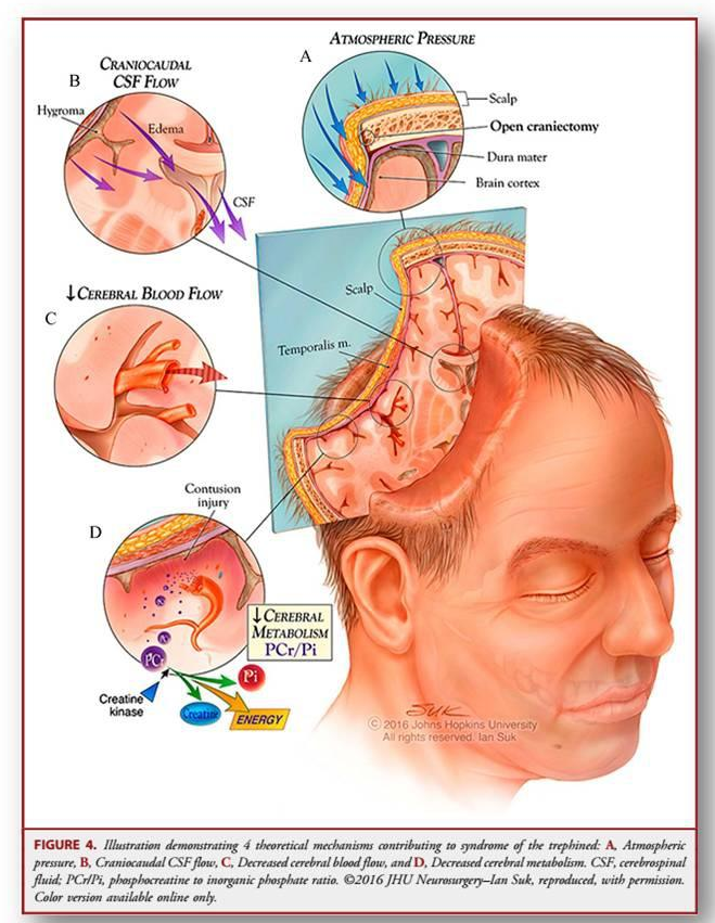 颅骨修复有哪些厂家既是美容也是保护，有了颅骨修补术，他笑了_https://www.jmylbn.com_新闻资讯_第4张