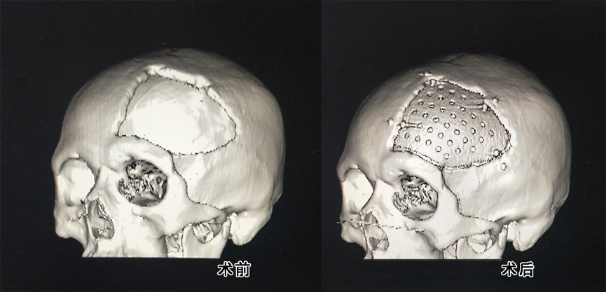 颅骨修复有哪些厂家既是美容也是保护，有了颅骨修补术，他笑了_https://www.jmylbn.com_新闻资讯_第7张