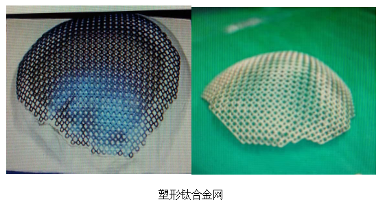 颅骨修复有哪些厂家既是美容也是保护，有了颅骨修补术，他笑了_https://www.jmylbn.com_新闻资讯_第5张