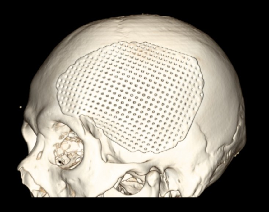 颅骨修复有哪些厂家既是美容也是保护，有了颅骨修补术，他笑了_https://www.jmylbn.com_新闻资讯_第6张
