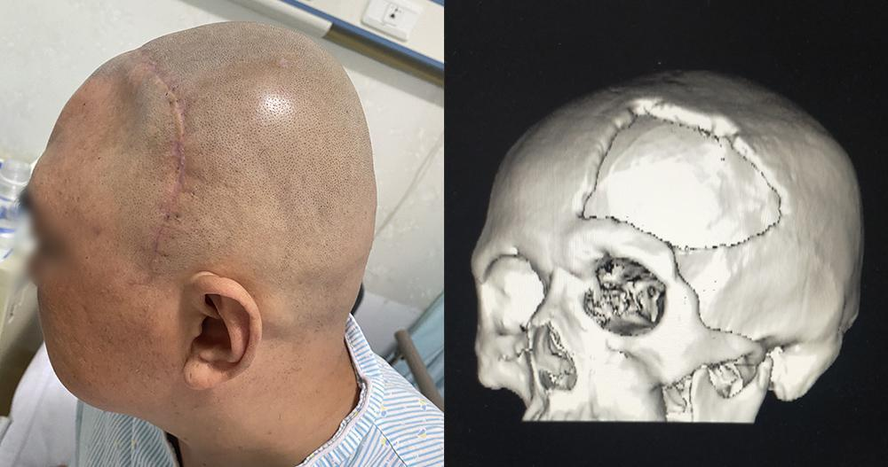 颅骨修复有哪些厂家既是美容也是保护，有了颅骨修补术，他笑了_https://www.jmylbn.com_新闻资讯_第3张