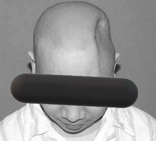 颅骨修复有哪些厂家既是美容也是保护，有了颅骨修补术，他笑了_https://www.jmylbn.com_新闻资讯_第2张