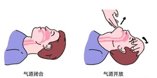 呼吸面罩怎么带麻醉科专业技术：面罩通气操作攻略_https://www.jmylbn.com_新闻资讯_第11张