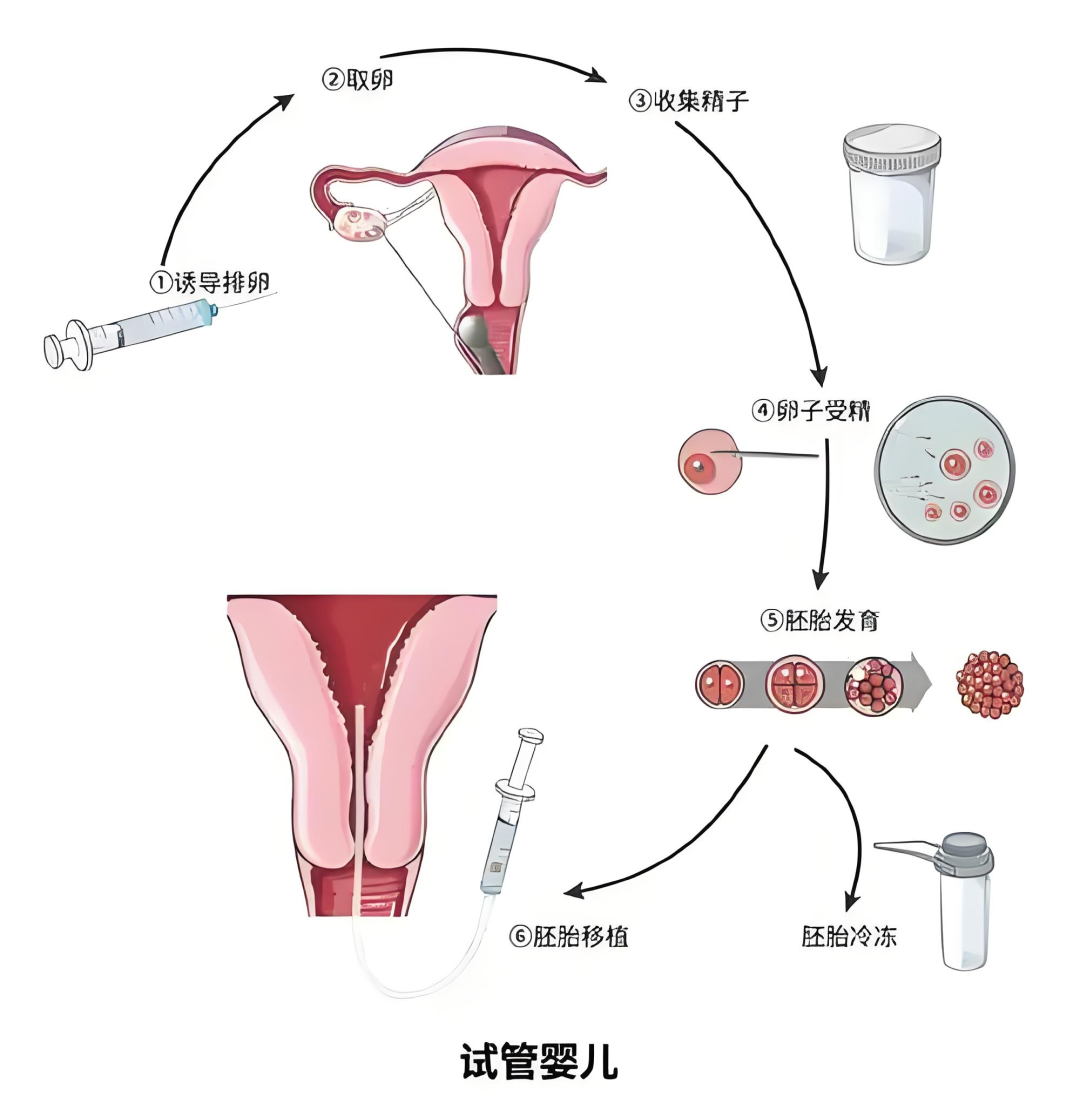 取卵针长什么样【健康科普】试管婴儿——无痛取卵篇_https://www.jmylbn.com_新闻资讯_第2张