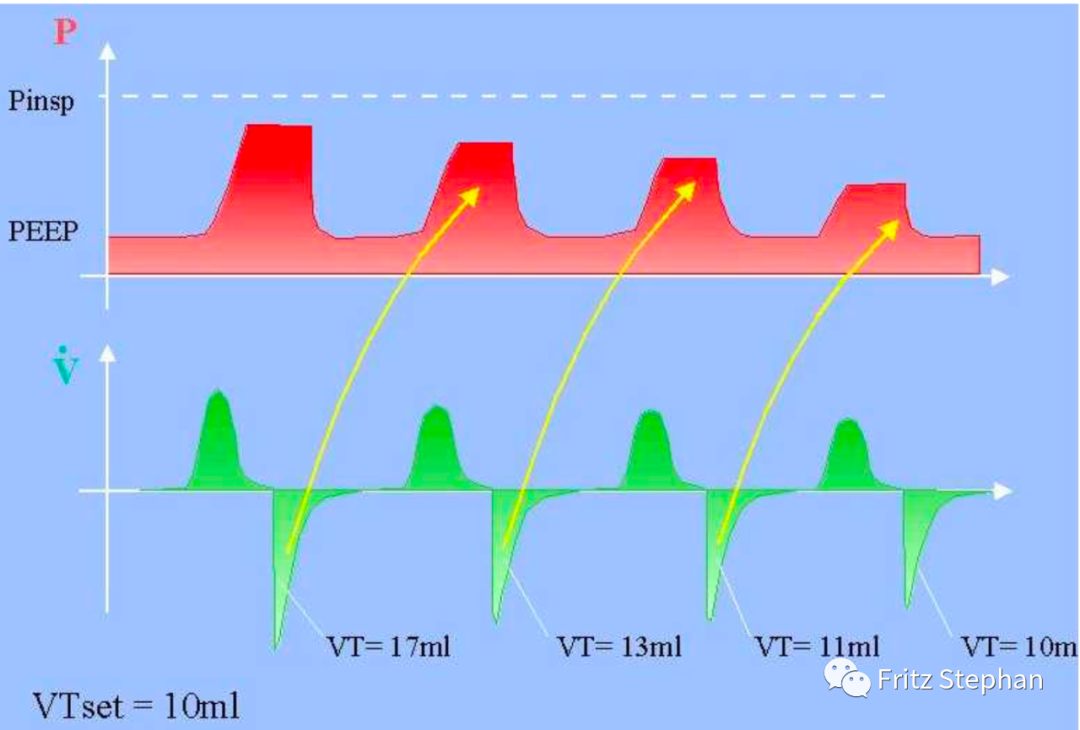 呼吸机pip是什么意思容量目标通气实操指南_https://www.jmylbn.com_新闻资讯_第1张