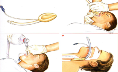 喉罩是什么喉罩全麻：解锁手术麻醉的神秘新方式_https://www.jmylbn.com_新闻资讯_第5张