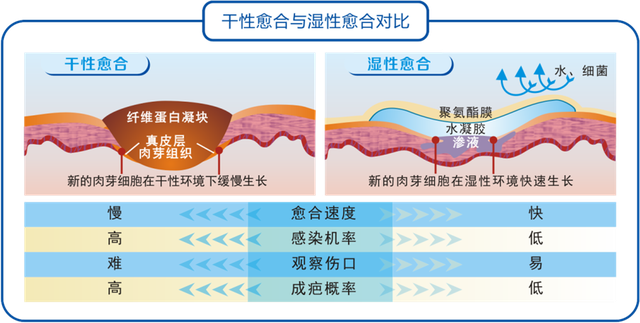 无菌敷料怎么用湿性愈合别乱用！这篇教你正确用法！_https://www.jmylbn.com_新闻资讯_第6张