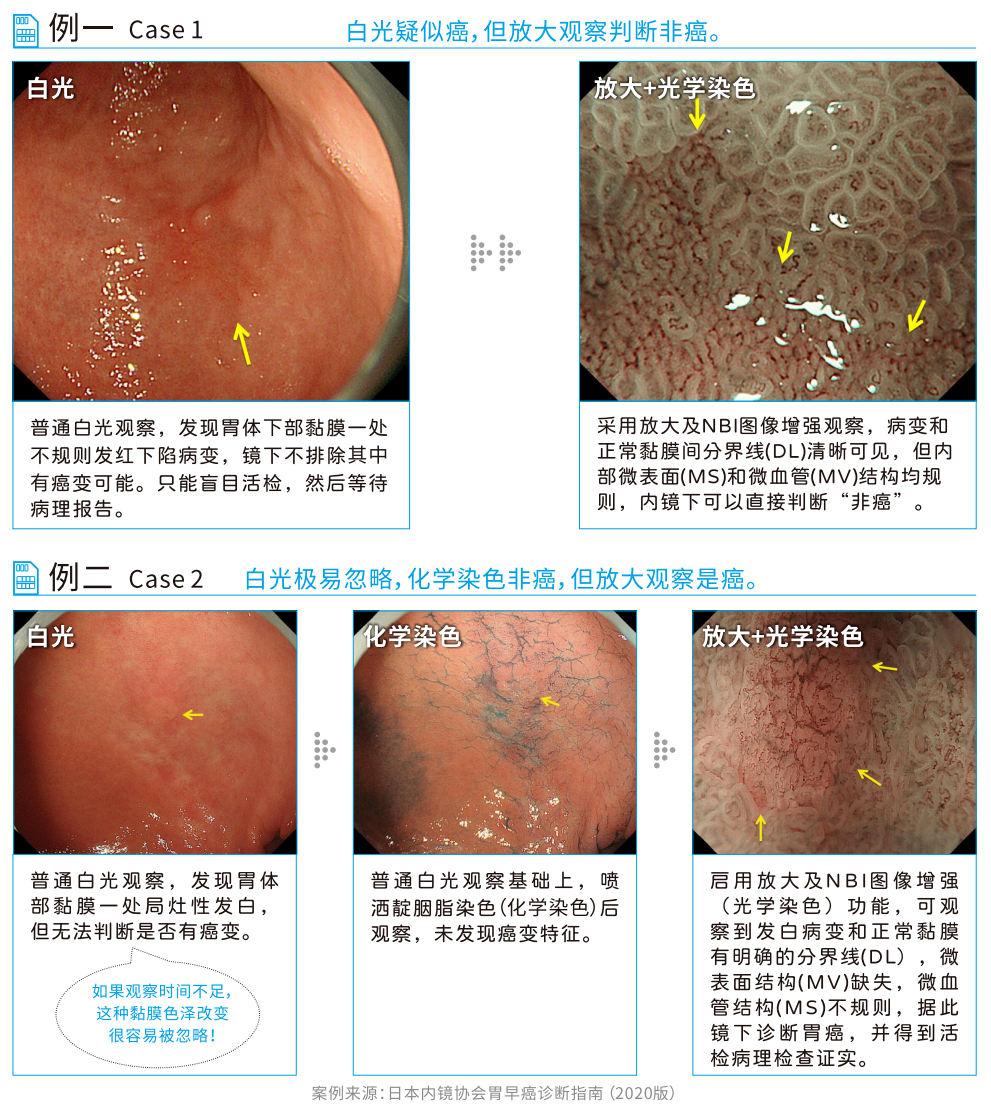 奥林巴斯胃肠镜怎么做漏诊？误诊？“内镜界福尔摩斯”奥林巴斯290无痛胃肠镜让微小病灶无所遁形_https://www.jmylbn.com_新闻资讯_第3张