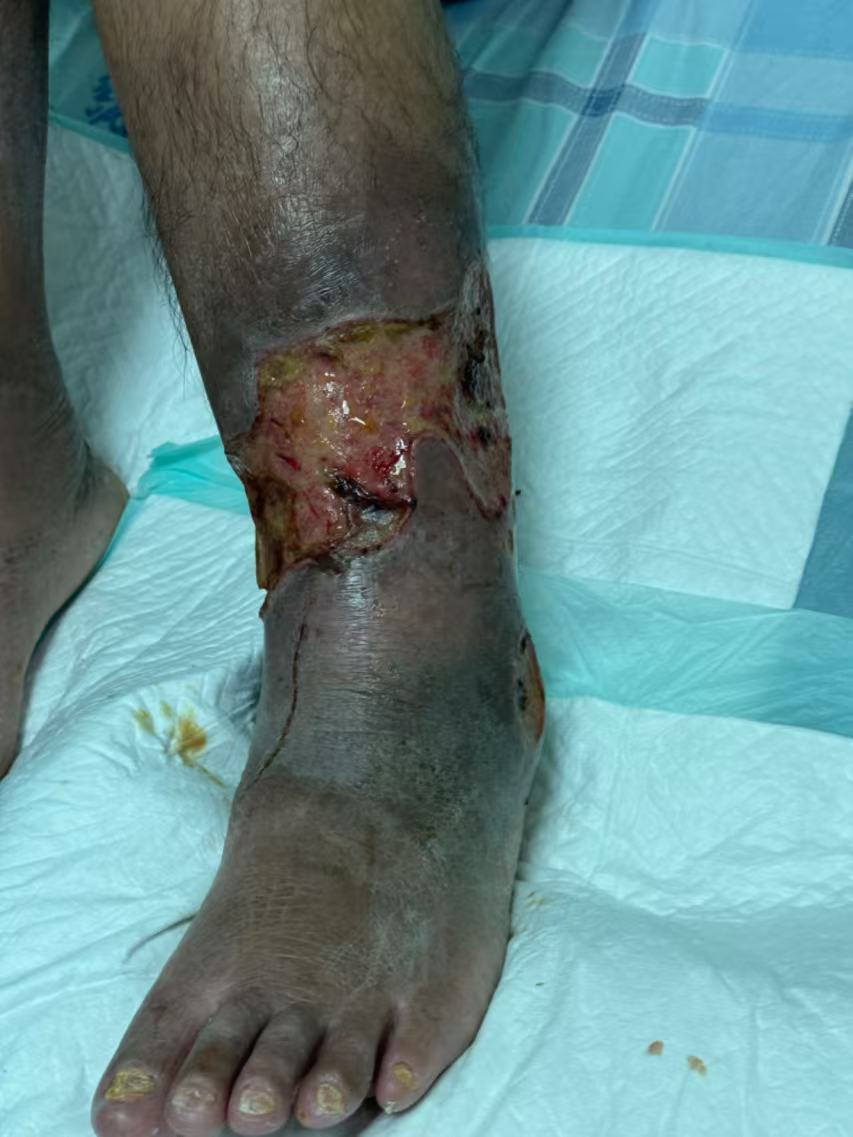 什么是vsd负压引流负压封闭引流术（VSD）：溃疡皮肤重生的福音_https://www.jmylbn.com_新闻资讯_第3张